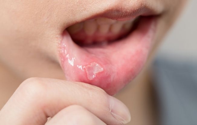 Cocuklarda-Agiz-Yaralari-ve-Aftlar